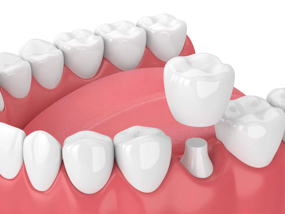 Dental Crowns and Bridges